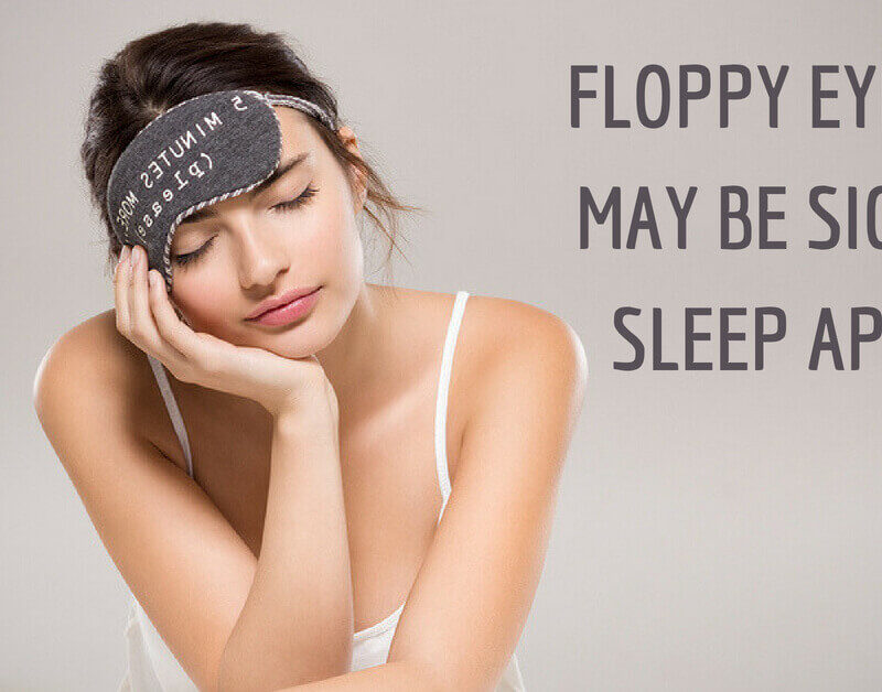 Floppy eyelids may be sign of sleep apnea